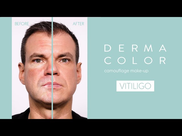 Cómo cubrir el vitíligo con Dermacolor | Tutorial de maquillaje Kryolan para una cobertura impecable