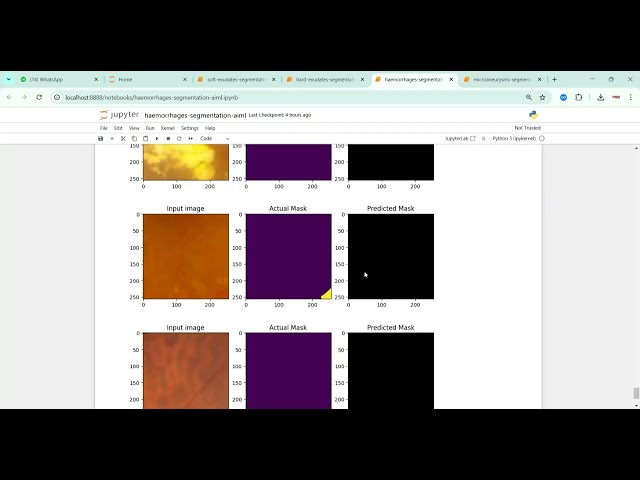 Diabetic Retinopathy Soft Exudates Segmentation Aiml in Python Projects