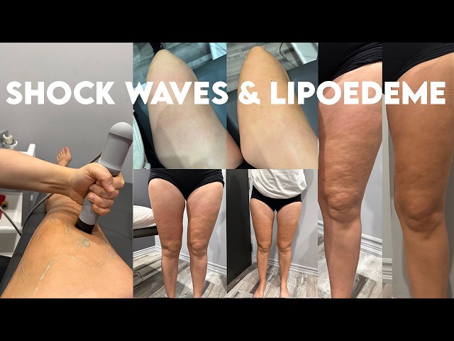 Shock wave therapy and lipedema: My experience after several months of treatment