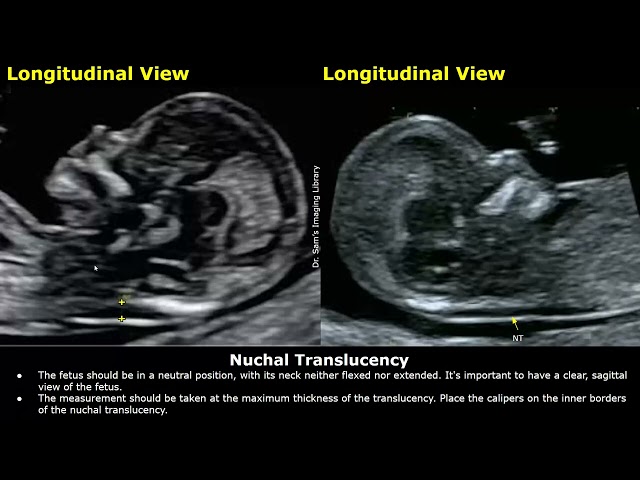 How to Measure Nuchal Translucency (NT) On Ultrasound | First Trimester NT Screening | Fetal USG