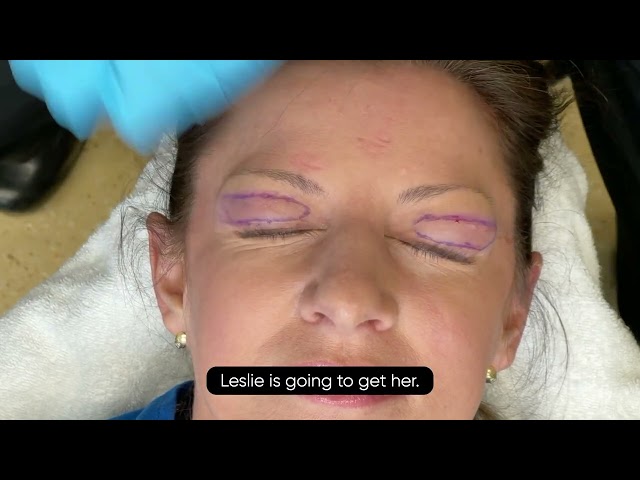 Live from the OR - Upper Eyelid Blepharoplasty LIVE Actual Surgery with Dr. Jon Mendelsohn (Graphic)