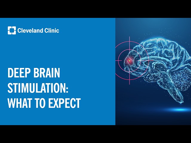 Deep Brain Stimulation: What To Expect