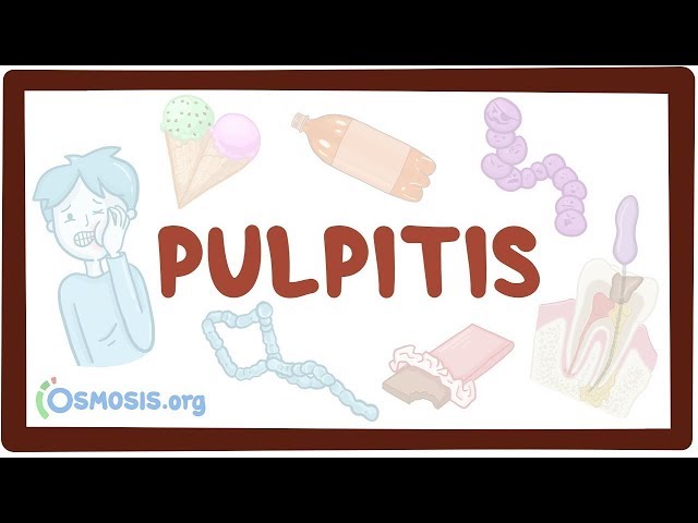 Pulpitis - causes, symptoms, diagnosis, treatment, pathology
