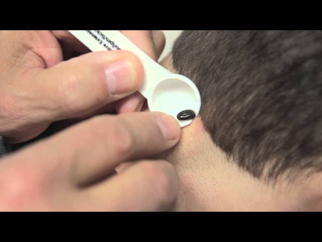 Tick Removal