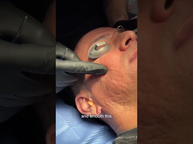 How Does Subcision Work For Stuck Acne Scars?