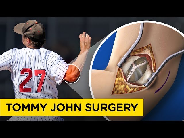 UCL Reconstruction Surgery (Tommy John Surgery) Medical Animation