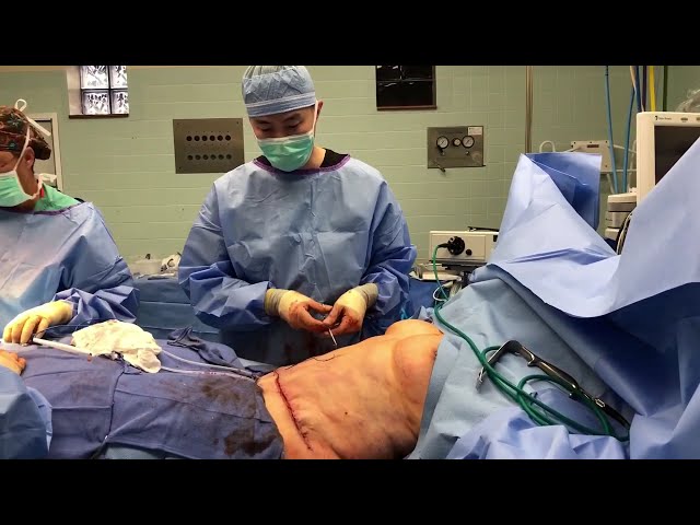 Abdominoplasty (Tummy Tuck) with Liposuction