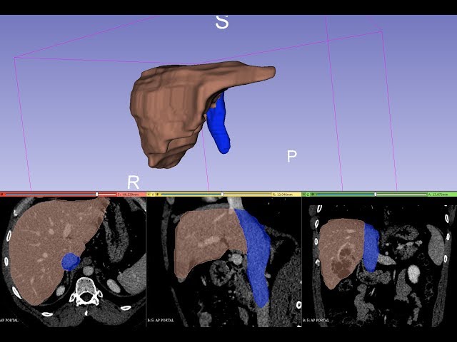 Organ segmentation 4.1 : Liver and inferior vena cava