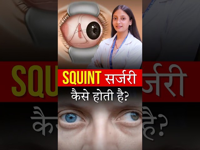 Squint (भेंगेपन) KI Surgery Kaise Ki Jati Hai?