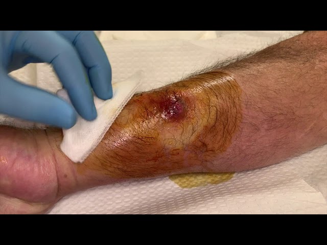 spiderbite to the arm