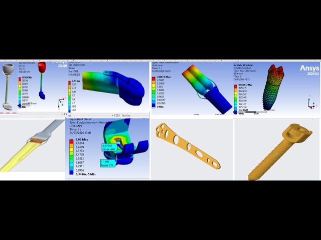 Biomedical Engineering Orthopedic Bioimplant's CAD Design & FEA Research Simulation:Solidworks ANSYS
