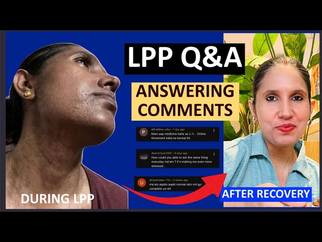 LPP (Lichen Planus Pigmentosus) | Answering Your Most Asked Questions | Honest Replies