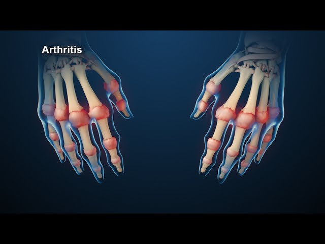 Rheumatoid Arthritis Animation