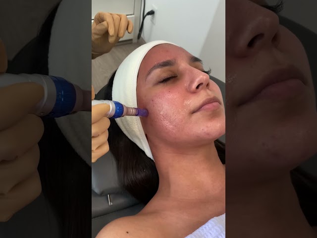Microneedling 😮😬💉 | Evoclinic