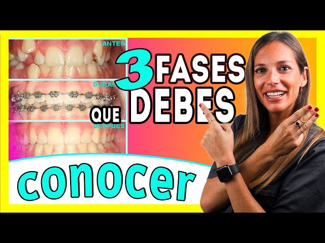 (Brackets process 𝗠𝗘𝗦 𝗮 𝗠𝗘𝗦 📆) The 5 𝐄𝐓𝐀𝐏𝐀𝐒 of Orthodontic TREATMENT - I'll explain it to you ✅ＦÁＣＩＬ