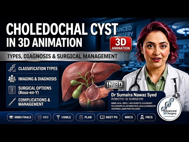 Choledochal Cyst  in 3D Animation Alonzo-Lej Classification