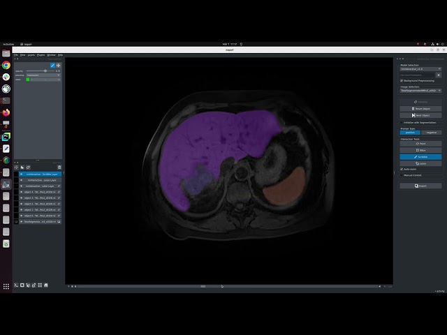 [Napari] MRI organ segmentation with nnInteractive
