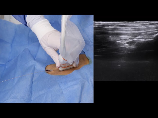 Linear Probe Right Sided Subclavian Central Venous Catheterisation