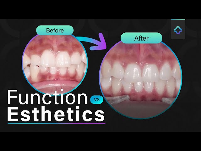 Should You Extract? How to Decide in Complex Invisalign® Cases - Ep. 20