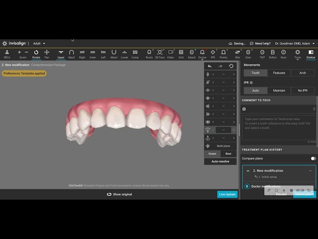Invisalign Providers- Watch this if You Want to See a Common Clincheck Error