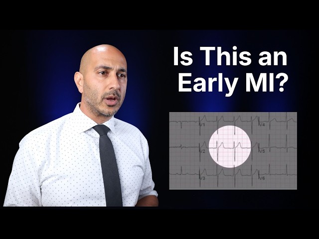 Hyperacute T Waves: The Earliest ECG Sign of Acute MI