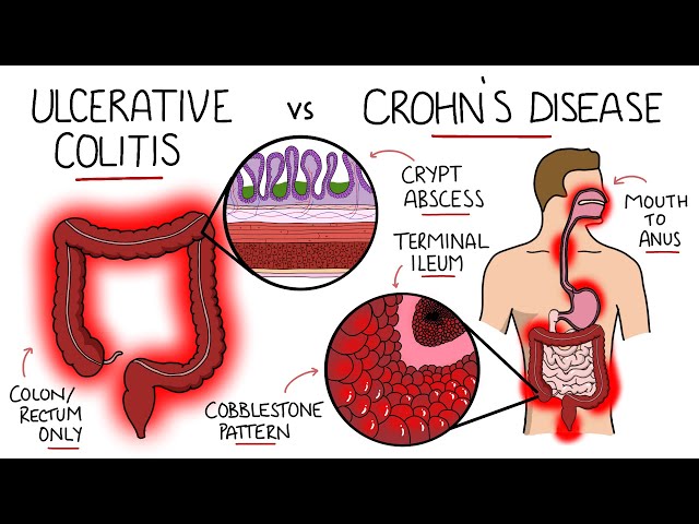 Enfermedad Inflamatoria Intestinal - Colitis Ulcerosa vs Enfermedad de Crohn (Con Histología y Ma...