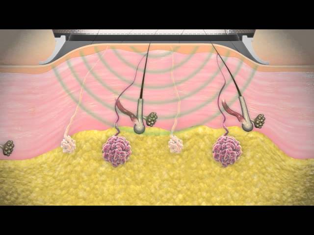 miraDry Procedure Video