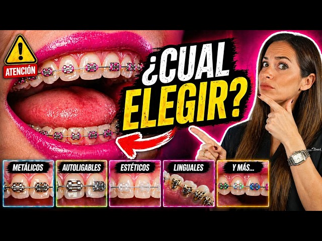 🔴Different TYPES OF BRACKETS - Which is better? (Metallic, Self-ligating, Aesthetic and MANY MORE)
