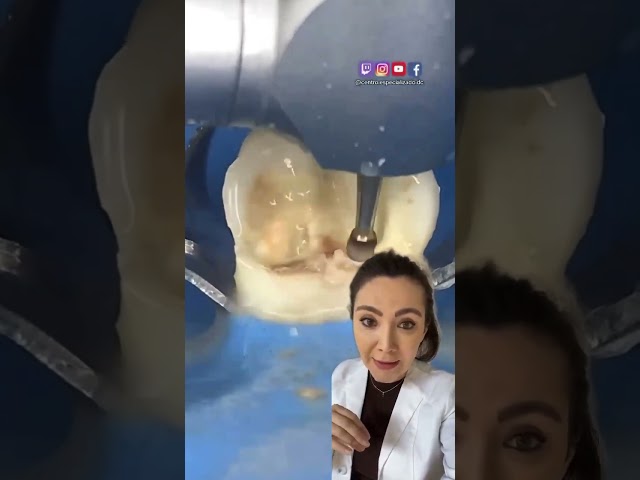 How Does Root Canal Treatment Work?!