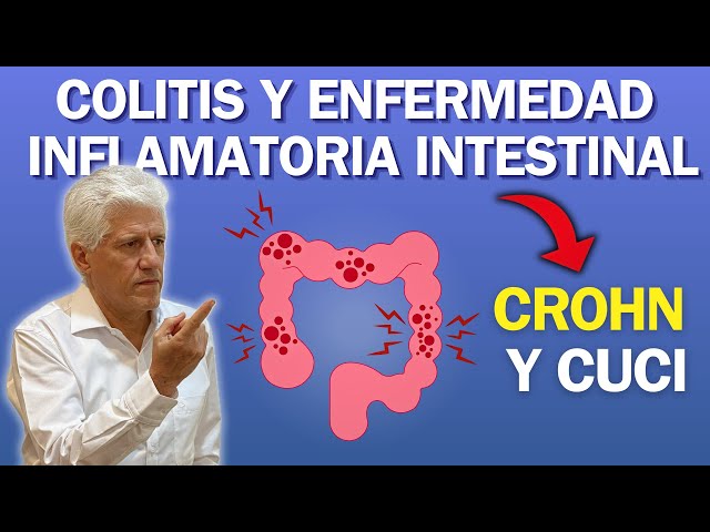 COLITIS y ENFERMEDAD INFLAMATORIA INTESTINAL (Crohn y CUCI)