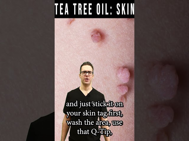 Skin Tag Removal & Wart Removal [Tea Tree Oil Natural Remedy]
