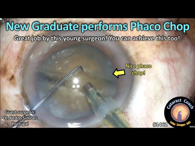 CataractCoach 1462: new graduate performs phaco chop