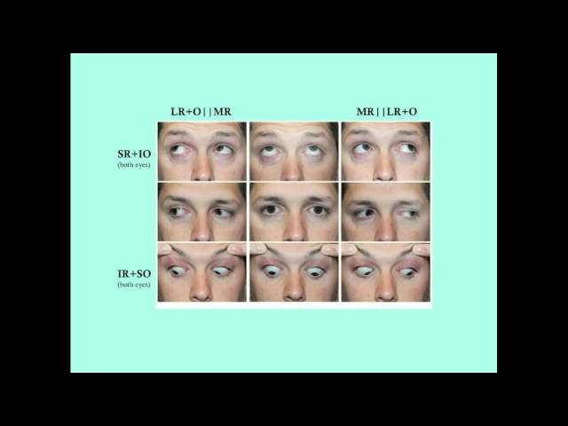 Strabismus - CRASH! Medical Review Series