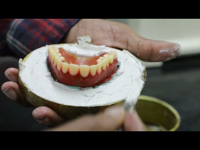 Essentials of Dental Materials Chapter 6 -  Compression moulding technique
