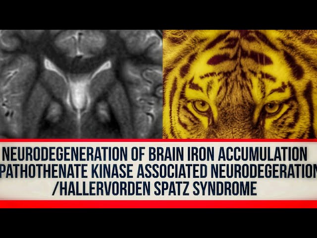 Neurodegeneration of brain iron accumulation/Hallervorden Spatz