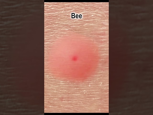 What Different Insect Bites Look Like