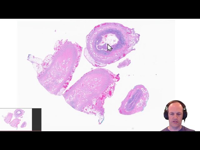 What is Appendicitis? What does appendicitis look like under the microscope?