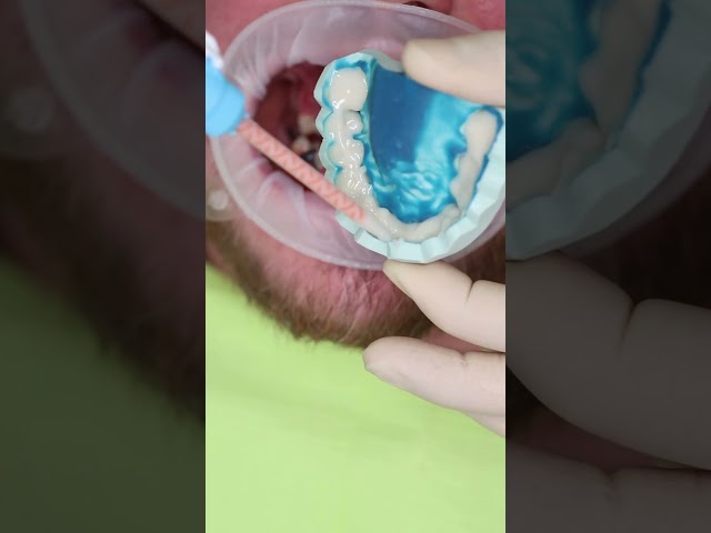 Wax up All on 4 in Prague #shorts #dentist #dental #implant #veneers #short