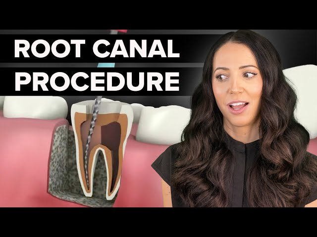 Dental Root Canal Step By Step