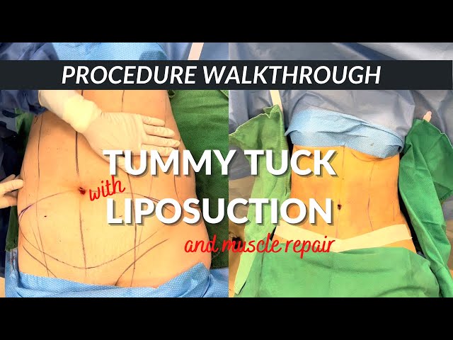 Tummy tuck and liposuction with Dr Rose | Six Surgery | Toronto