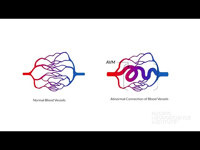 A PNI Minute | What Are Arteriovenous Malformations (AVM)