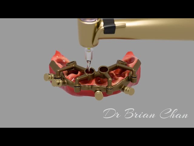 Fully Guided Surgery X Full Digital Workflow by Blender, BlueSkyPlan & Meshmixer