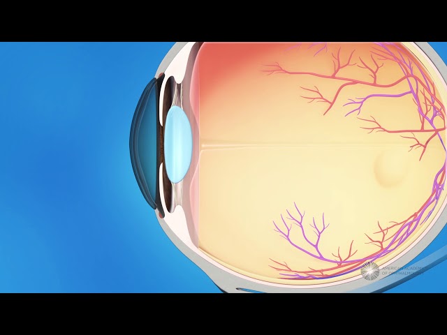 What is glaucoma?