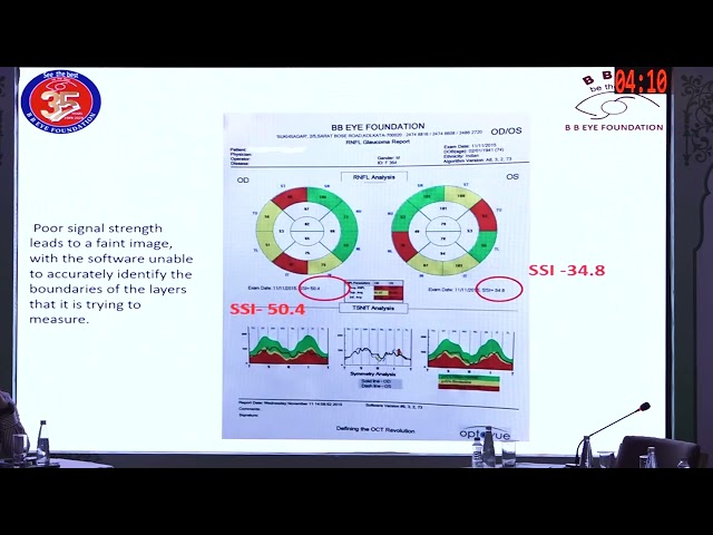 AIOC2026   IC75 Glaucoma Artifacts in Oct and Visual Field Dr Chandrima Paul