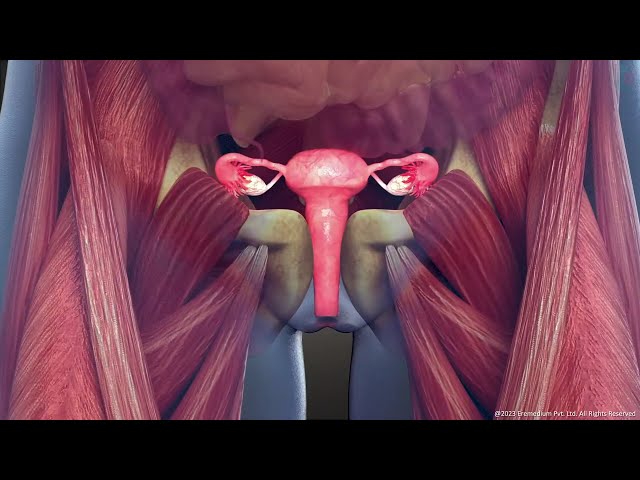 What is Intramural Uterine Fibroid: Symptoms and Treatment | 3D Guide