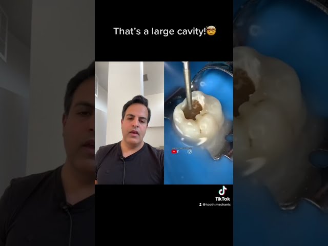 one of the LARGEST cavities i have seen🤯#Shorts #Dentistry #Cavity#decay.