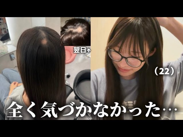 I developed alopecia areata at 22