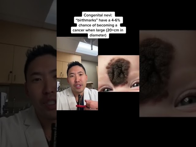 #shorts Congenital Nevus removed from the face