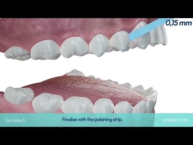 "Smiletech Interproximal Reduction (IPR/Stripping) in Invisible Orthodontics - ENG"