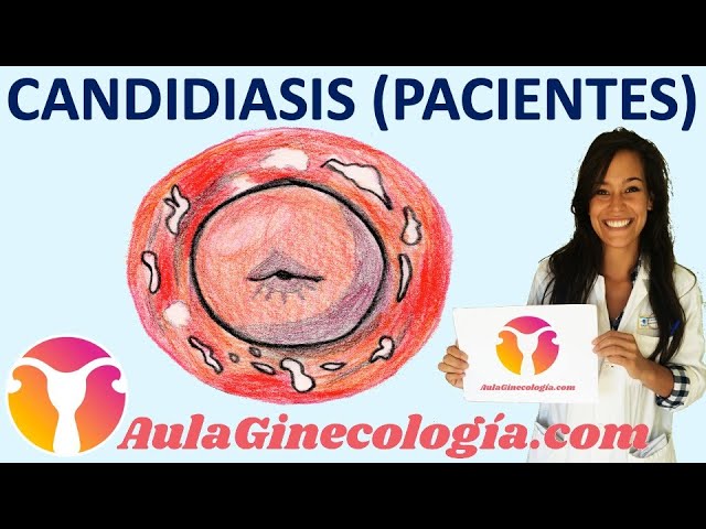CANDIDIASIS VAGINAL (PACIENTES): Causas, síntomas, tratamiento   - Ginecología y Obstetricia -